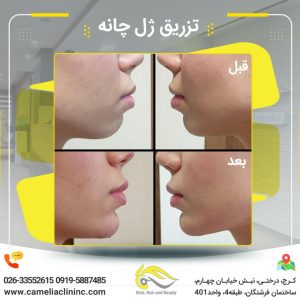 تزریق فیلر چانه کلینیک کاملیا کرج