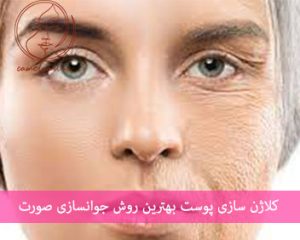 کلاژن سازی پوست صورت در کرج