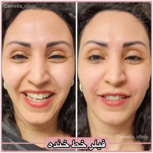 فیلر خط خنده-کلینیک کاملیا-گلشهر-کرج