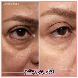 فیلر زیر چشم 2-کلینیک کاملیا-گلشهر-کرج