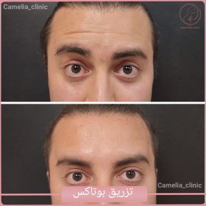 تزریق بوتاکس-کلینیک کاملیا گلشهر کرج-1