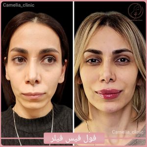 فول فیس فیلر-کلینیک کاملیا-گلشهر کرج-1