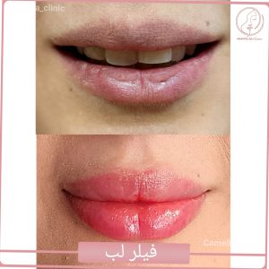 فیلر لب-کلینیک کاملیا گلشهر کرج-3