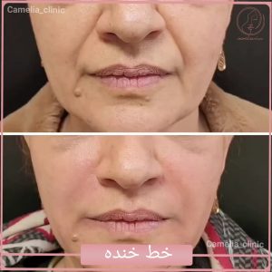 تزریق فیلر خط خنده در کرج-کلینیک کاملیا-گلشهر-1