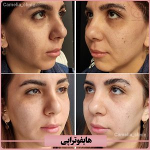 بهترین مرکز هایفوتراپی-کلینیک کاملیا کرج
