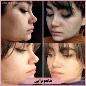 هایفوتراپی-کلینیک کاملیا کرج4
